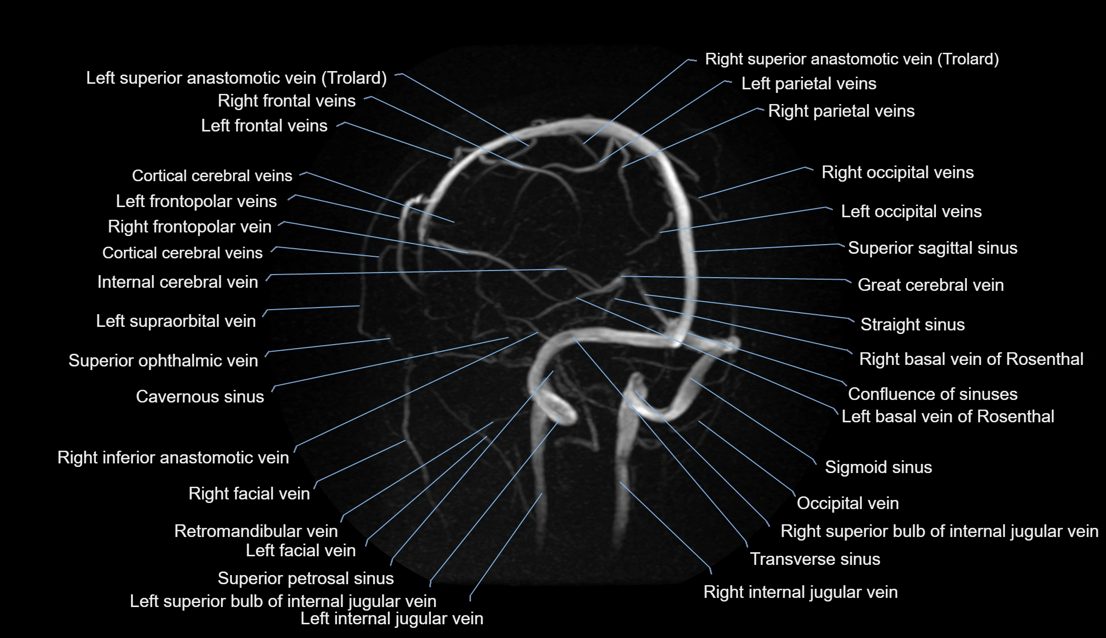 MRV brain MIP sagittal labelled anatomy 3T MRI images -img-1011001-00008.webp